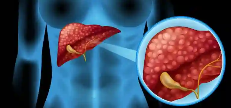 Role of PET scan in Pancreatic Cancer: Uses, Preparation, Procedure & Cost